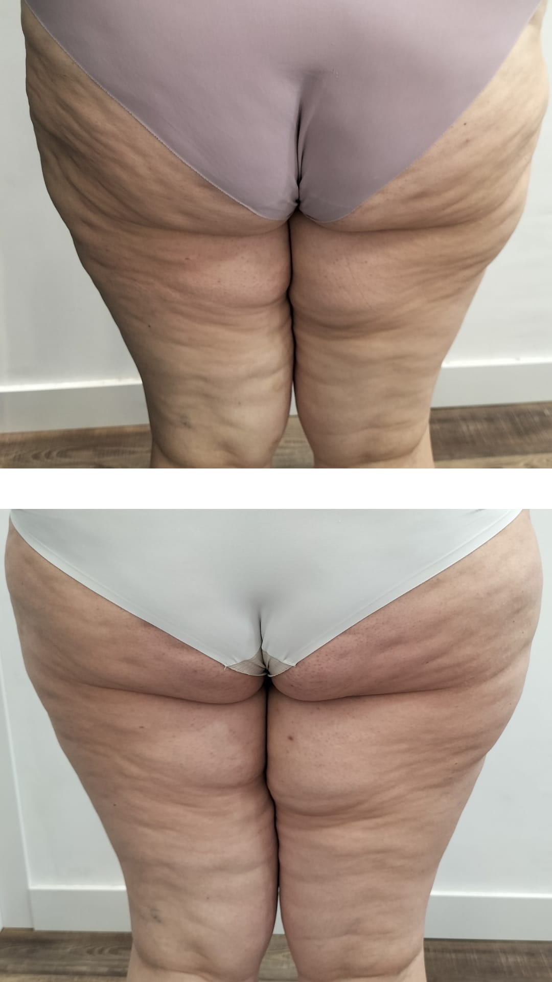 CELULITIS ANTES Y DESPUES